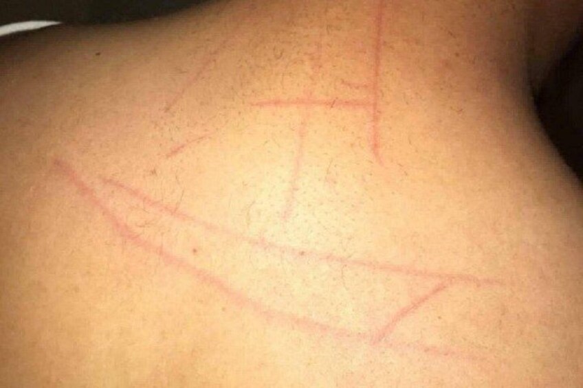 A person's back with visible red marks. 2