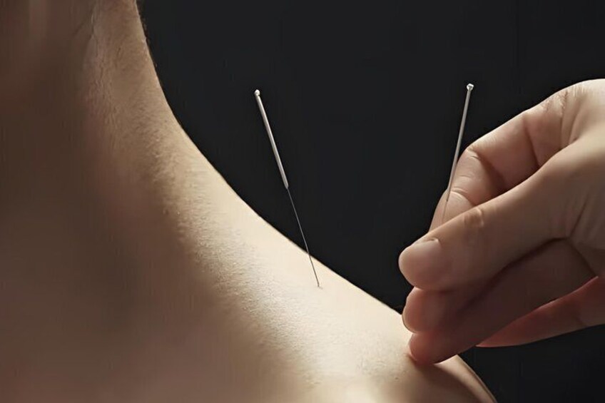 A close-up of a person's back with acupuncture needles inserted. 3