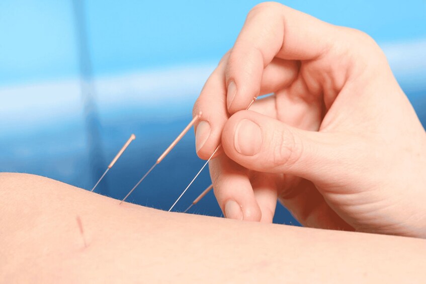 A hand inserting acupuncture needles into a person's skin. 1