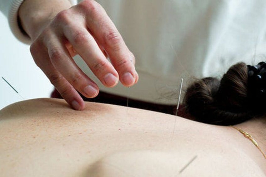 A person receiving acupuncture treatment with needles inserted into their back. 2